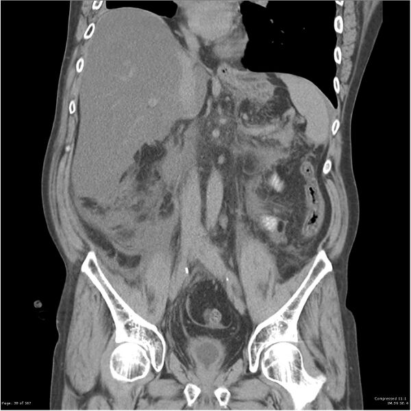 File:Acute pancreatitis (Radiopaedia 19135-19116 Coronal non-contrast 24).jpg
