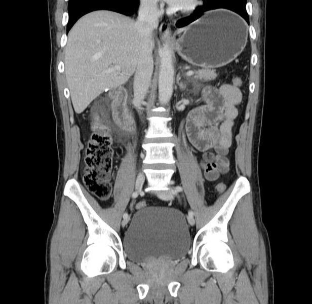 File:Acute pancreatitis (Radiopaedia 22572-22596 Coronal C+ portal venous phase 29).jpg