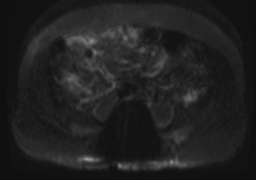 Acute portal vein thrombosis (Radiopaedia 73198-83925 Axial DWI 29).jpg