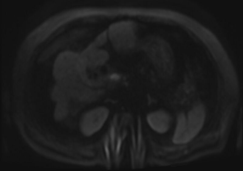 File:Acute portal vein thrombosis (Radiopaedia 73198-83925 Axial DWI 75).jpg