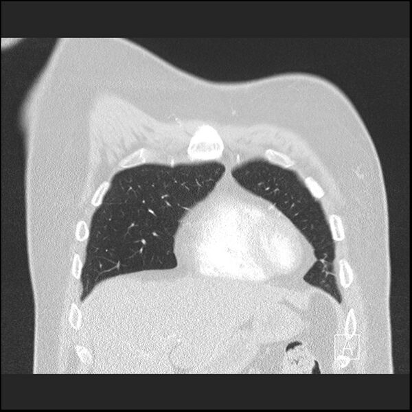 File:Acute pulmonary embolism with pulmonary infarct (Radiopaedia 73062-83768 Coronal lung window 14).jpg