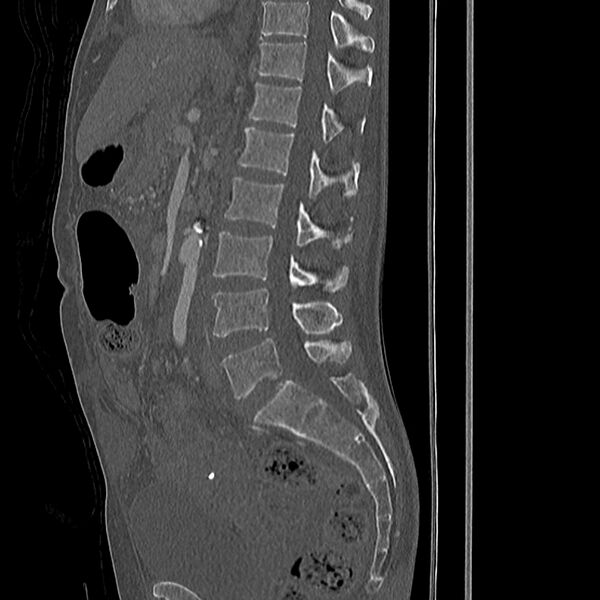 File:Acute vertebral body compression fractures (Radiopaedia 31757-32693 Sagittal bone window 27).jpg