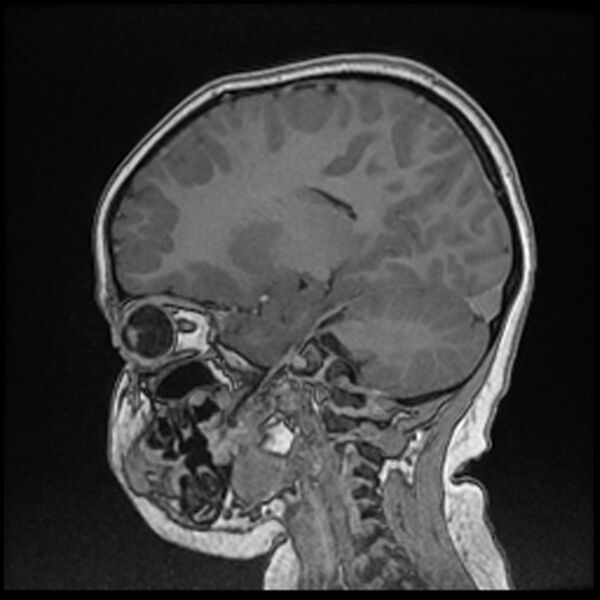 File:Adamantinomatous craniopharyngioma (Radiopaedia 77407-89529 Sagittal T1 C+ 84).jpg