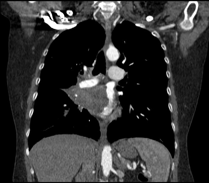File:Adenocarcinoma of the lung (Radiopaedia 44205-47803 Coronal C+ portal venous phase 48).jpg