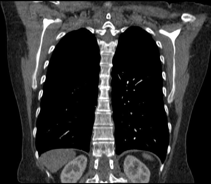 File:Adenocarcinoma of the lung (Radiopaedia 44205-47803 Coronal C+ portal venous phase 72).jpg