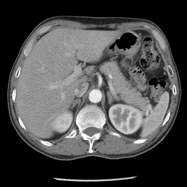File:Adenocarcinoma of the lung - micropapillary predominant (Radiopaedia 42446-45563 Axial C+ portal venous phase 73).jpg