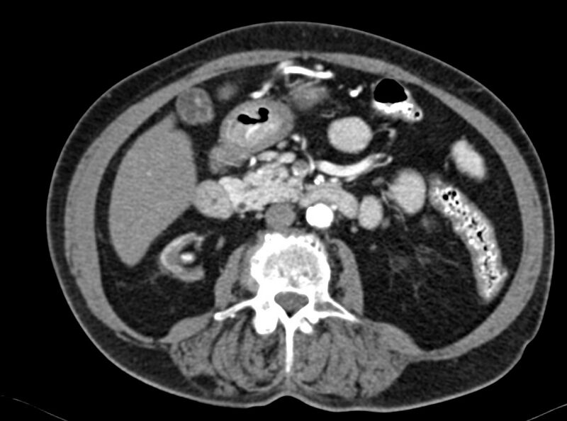 File:Adenomyomatosis of the gallbladder (Radiopaedia 12142-12483 Axial C+ arterial phase 19).jpg
