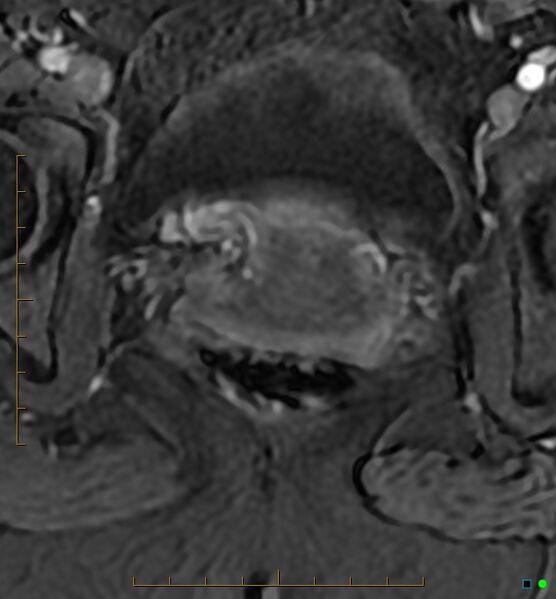 File:Adenomyosis uterus with hematometra (Radiopaedia 45779-50011 Axial T1 C+ fat sat 52).jpg