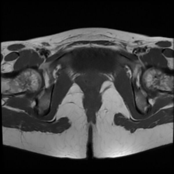 File:Adenomyosis within a septate uterus (Radiopaedia 69963-79981 Axial T1 24).jpg