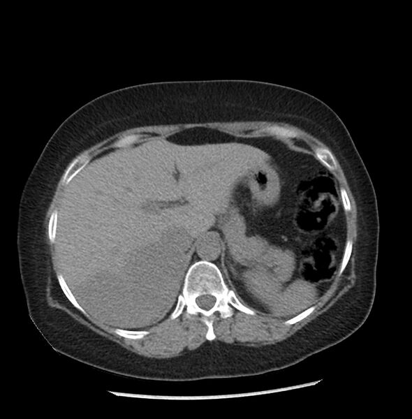 File:Adrenal cortical carcinoma with IVC invasion and thrombosis (Radiopaedia 34307-35597 Axial non-contrast 10).jpg