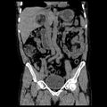 Adrenal myelolipoma (Radiopaedia 41843-44834 Coronal non-contrast 1).jpg