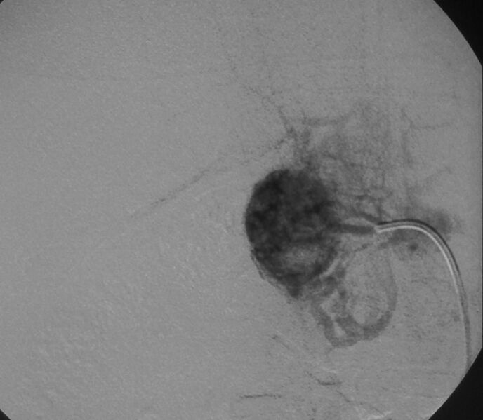 File:Adrenal remnant after nephrectomy (Radiopaedia 15936-15586 D 1).jpg