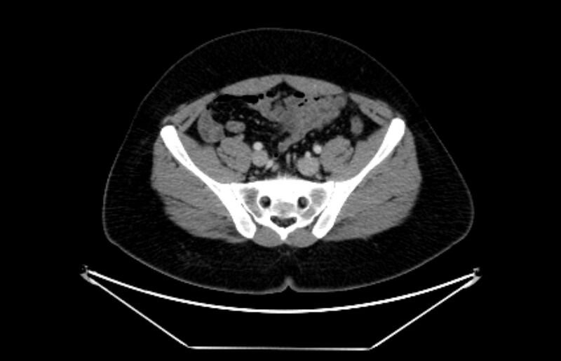 File:Adrenocortical carcinoma (Radiopaedia 80134-93438 Axial C+ portal venous phase 100).jpg