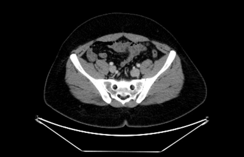 File:Adrenocortical carcinoma (Radiopaedia 80134-93438 Axial C+ portal venous phase 101).jpg