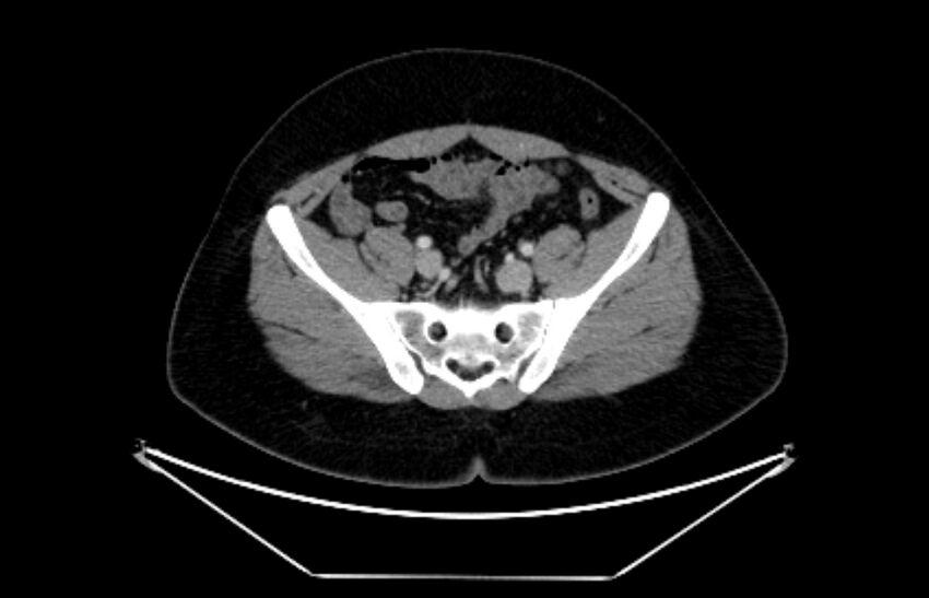 Adrenocortical carcinoma (Radiopaedia 80134-93438 Axial C+ portal venous phase 101).jpg