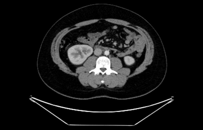 File:Adrenocortical carcinoma (Radiopaedia 80134-93438 Axial C+ portal venous phase 67).jpg