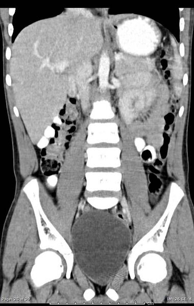 File:Agenesis of the gallbladder (Radiopaedia 55454-61905 A 25).jpg