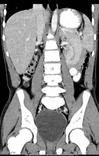 File:Agenesis of the gallbladder (Radiopaedia 55454-61905 A 28).jpg