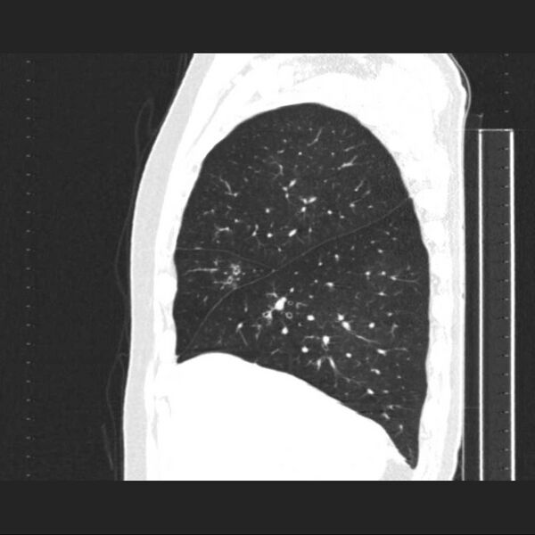 File:Allergic bronchopulmonary aspergillosis (Radiopaedia 21386-21320 Sagittal lung window 15).jpg
