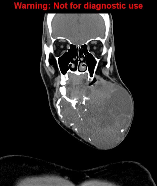 File:Ameloblastoma (Radiopaedia 33126-34164 D 24).jpg
