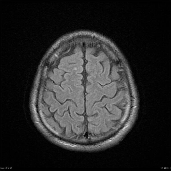 File:Amnestic syndrome secondary to hypoxic brain injury (Radiopaedia 24743-25004 FLAIR 18).jpg