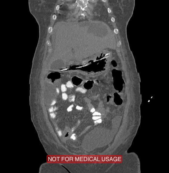File:Amoebic enterocolitis with liver abscess (Radiopaedia 35100-36609 B 27).jpg