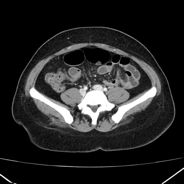 File:Ampullary tumor (Radiopaedia 22787-22816 C 46).jpg