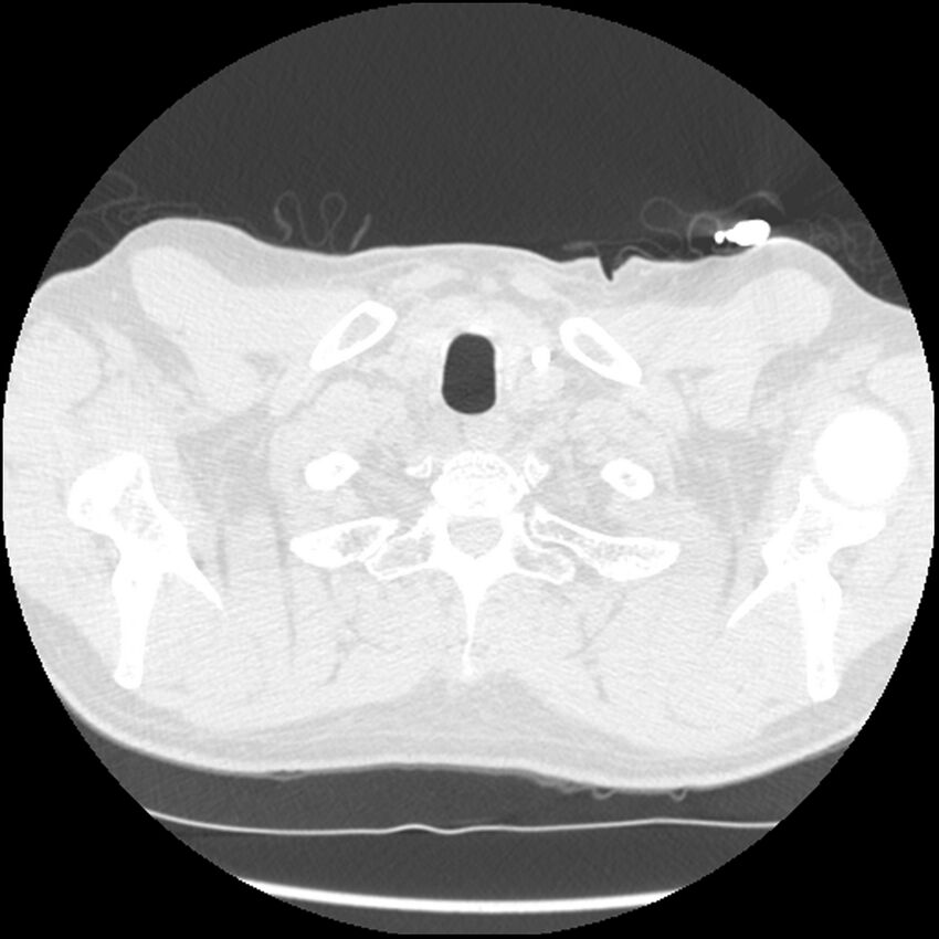 Angioinvasive aspergillosis (Radiopaedia 43957-47466 Axial lung window 5).jpg