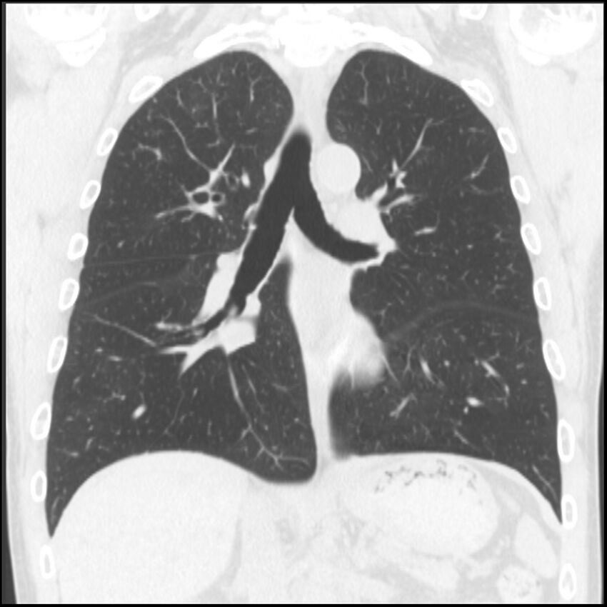 Angioinvasive aspergillosis (Radiopaedia 43957-47466 Coronal lung window 44).jpg