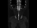 Ankylosing spondylitis (Radiopaedia 44609-48357 Coronal bone window 91).jpg