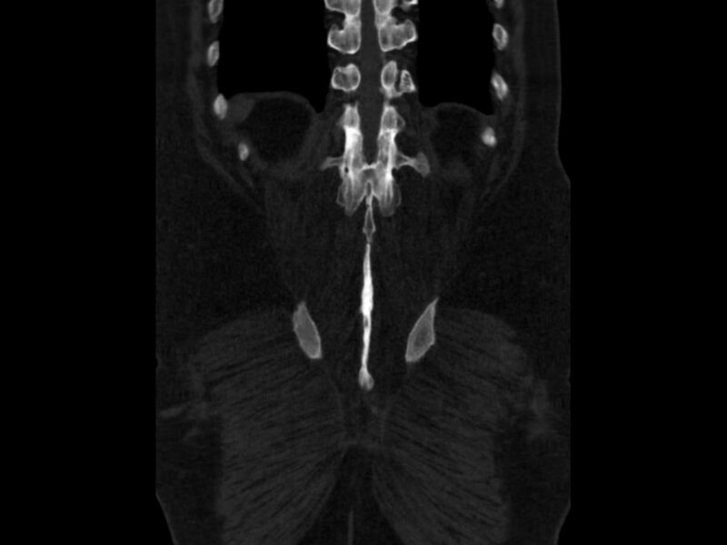 File:Ankylosing spondylitis (Radiopaedia 44609-48357 Coronal bone window 91).jpg