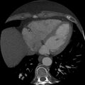 Anomalous origin of left circumflex artery from right coronary sinus (Radiopaedia 72563-83117 A 16).jpg