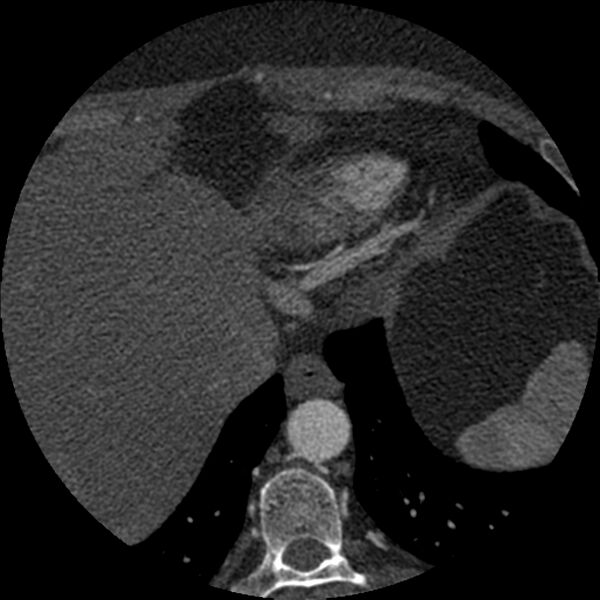 File:Anomalous origin of left circumflex artery from right coronary sinus (Radiopaedia 72563-83117 B 163).jpg