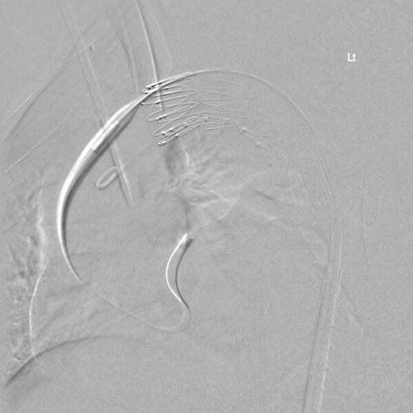 File:Aortic arch false aneurysm (Radiopaedia 14667-14589 Final result 1).jpg
