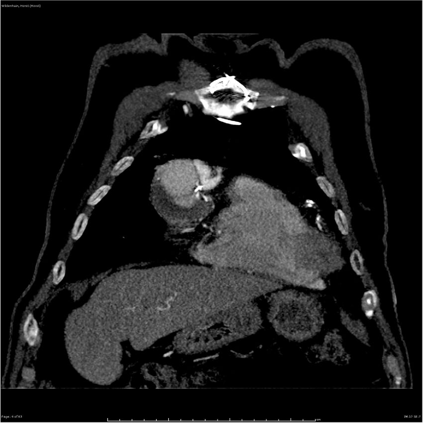 Aortic dissection - Stanford type A (Radiopaedia 26183-26315 A 4).jpg