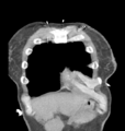 Aortic valve non-coronary cusp thrombus (Radiopaedia 55661-62189 C 13).png