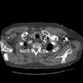 Aorto-coronary bypass graft aneurysms (Radiopaedia 40562-43157 A 14).png