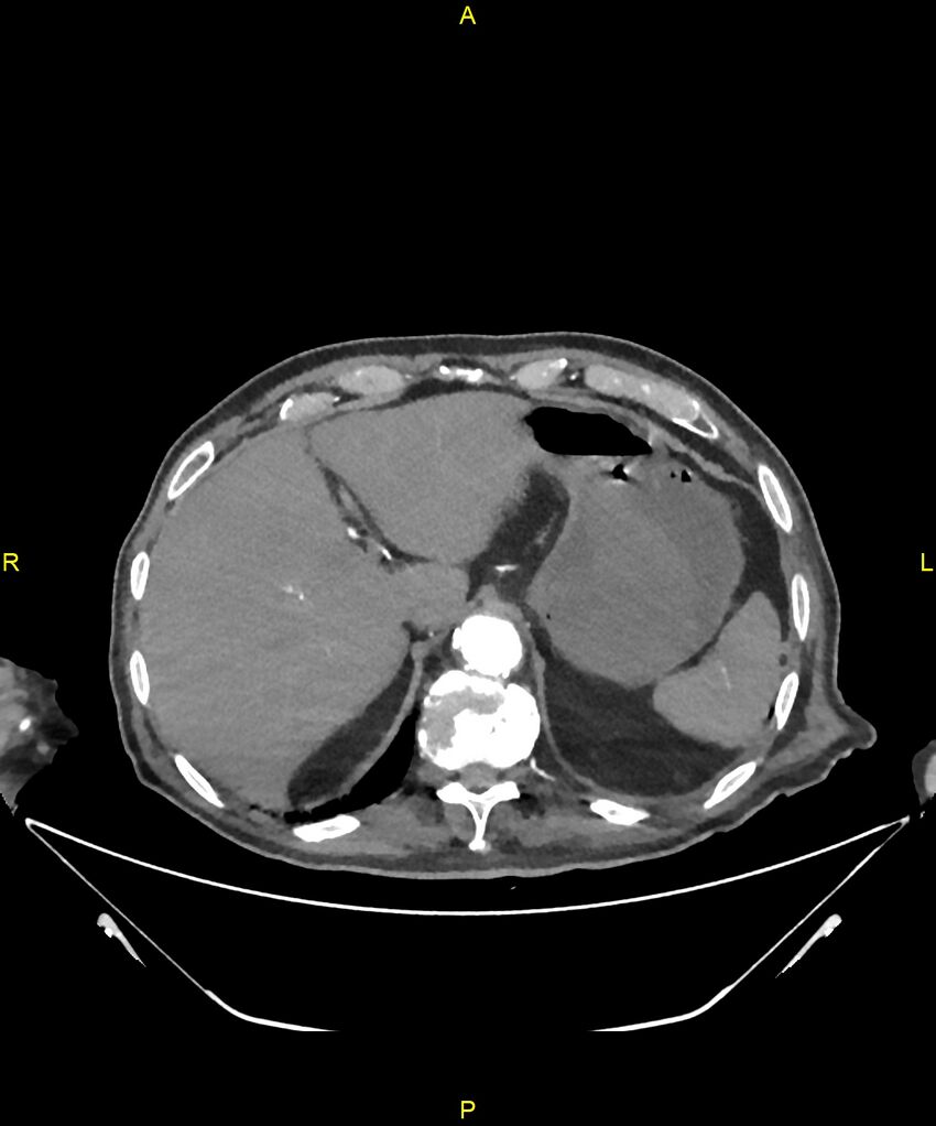 Aortoenteric fistula (Radiopaedia 84308-99603 B 52).jpg
