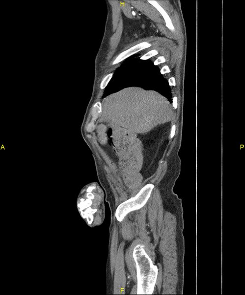 File:Aortoenteric fistula (Radiopaedia 84308-99603 C 49).jpg