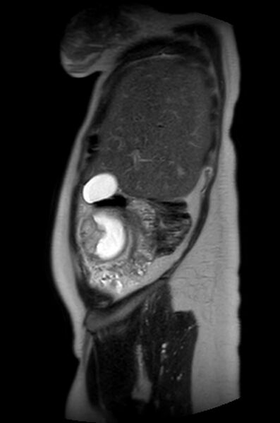 File:Appendicitis in gravida (MRI) (Radiopaedia 89433-106395 Sagittal T2 55).jpg