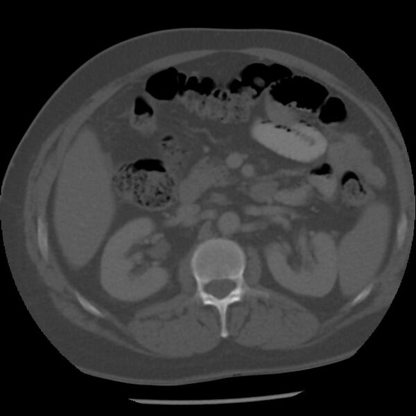File:Appendicitis with perforation (Radiopaedia 35790-37342 Axial bone window 20).jpg