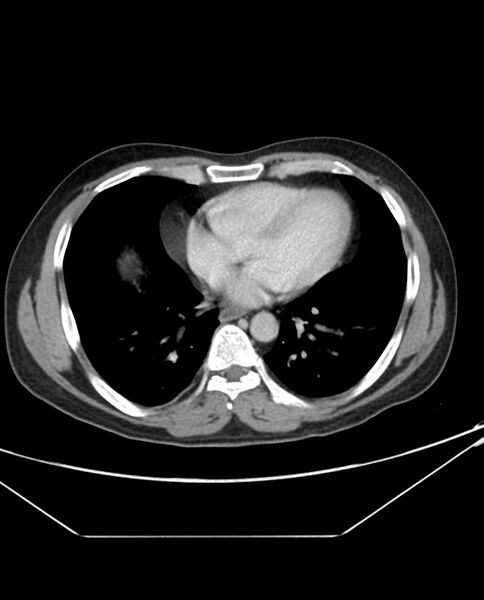 File:Arterial occlusive mesenteric ischemia (Radiopaedia 84641-100054 A 2).jpg