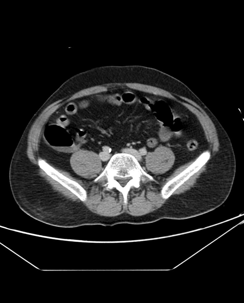 Arterial occlusive mesenteric ischemia (Radiopaedia 84641-100054 A 82).jpg