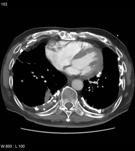 File:Asbestos related lung and pleural disease (Radiopaedia 14377-14301 D 39).jpg