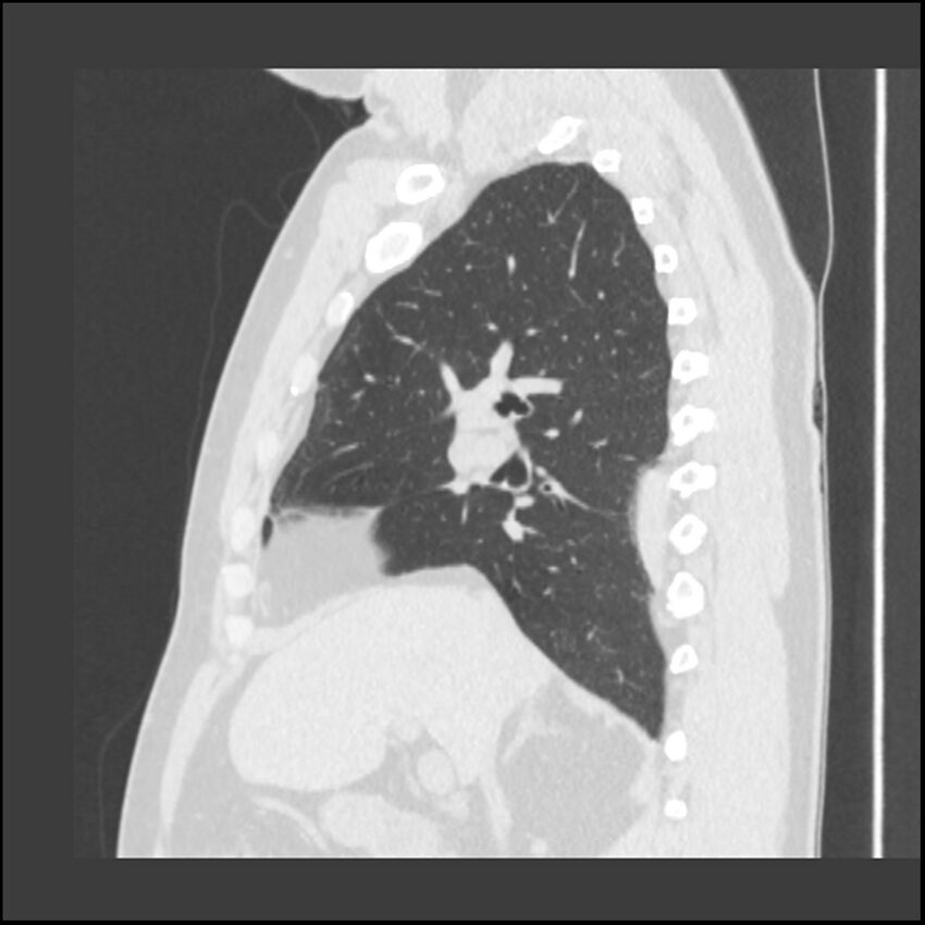 Asbestosis (Radiopaedia 45002-48961 Sagittal lung window 84).jpg