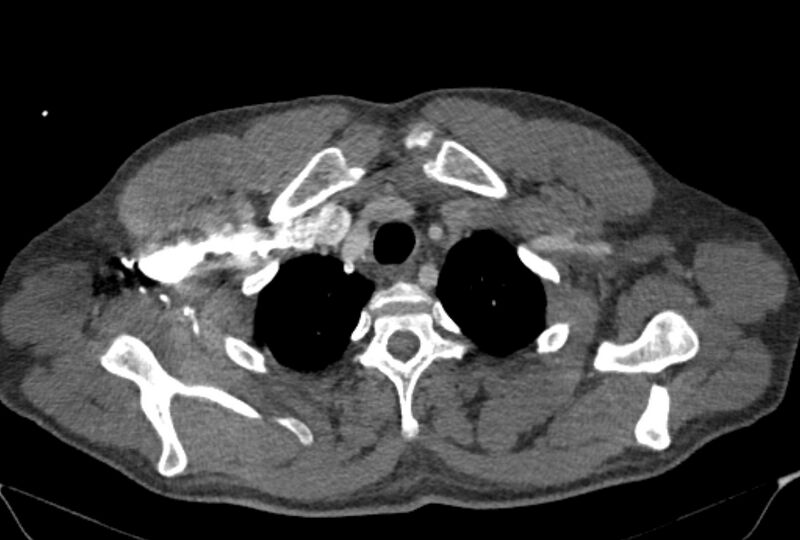 File:Ascending aortic aneurysm (Radiopaedia 86279-102297 C 5).jpg