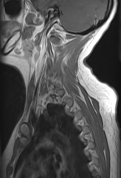 File:Astrocytoma - spinal cord (Radiopaedia 69769-79758 Sagittal T1 C+ 12).jpg