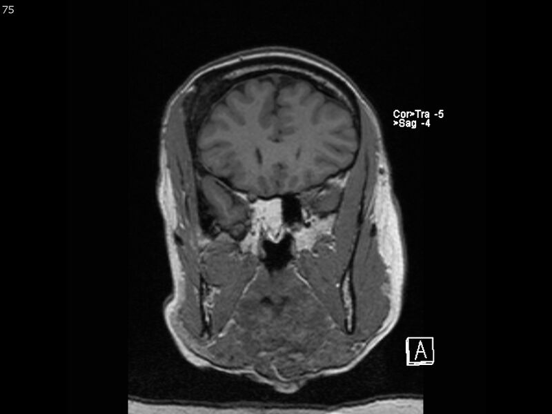 File:Atypical meningioma - intraosseous (Radiopaedia 64915-74572 Coronal T1 75).jpg