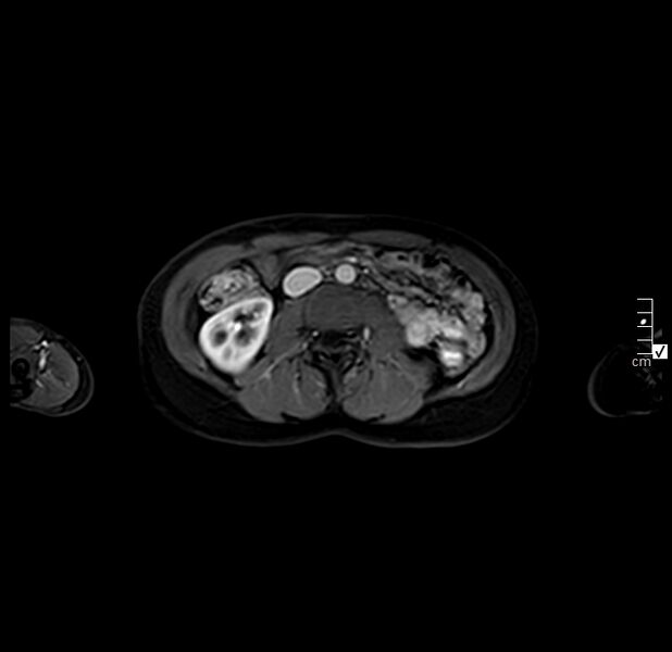 File:Autoimmune pancreatitis (Radiopaedia 40166-42675 Axial arterial phase 12).JPG