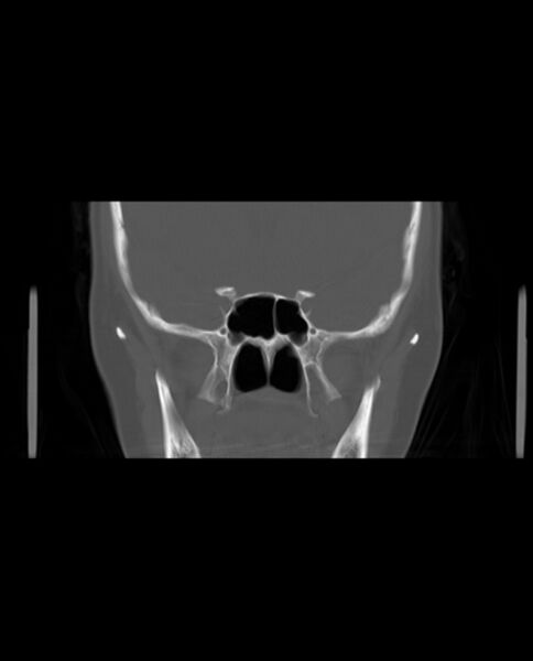 File:Automastoidectomy with labyrinthine fistula (Radiopaedia 84143-99411 Coronal non-contrast 59).jpg